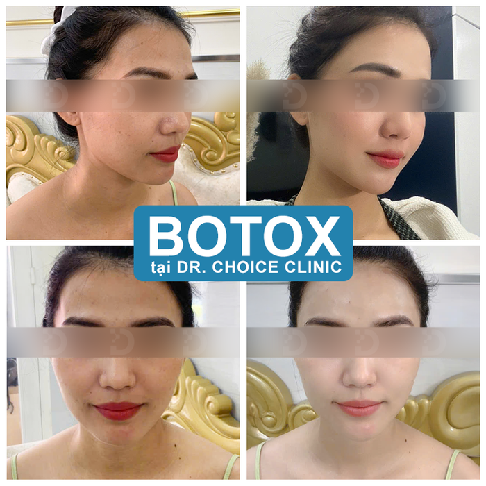 Botox hcm uy tin.png