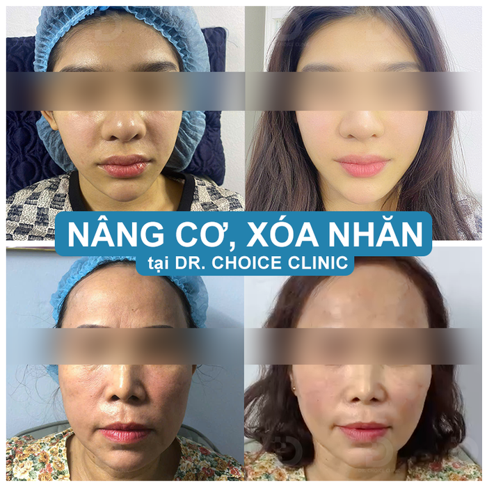 Nang co xoa nhan tai dr choice clinic hcm.png