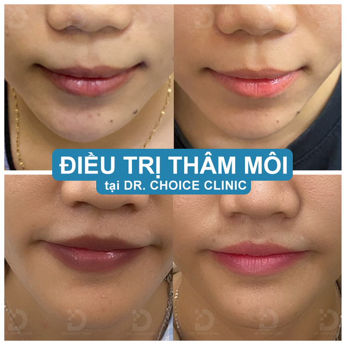 dieu tri tham moi hieu qua hcm.png
