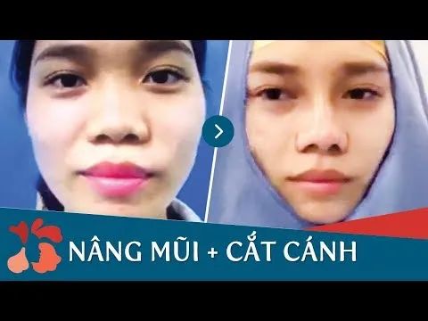 Video hướng dẫn quy trình thu gọn cánh mũi