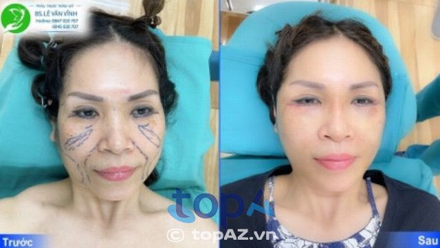 Dịch vụ cấy mỡ trẻ hóa da do bác sĩ Lê Văn Vĩnh trực tiếp đảm nhận với quy trình chuẩn xác, an toàn tuyệt đối, giúp khách hàng lấy lại nét tươi trẻ và rạng rỡ tự nhiên.