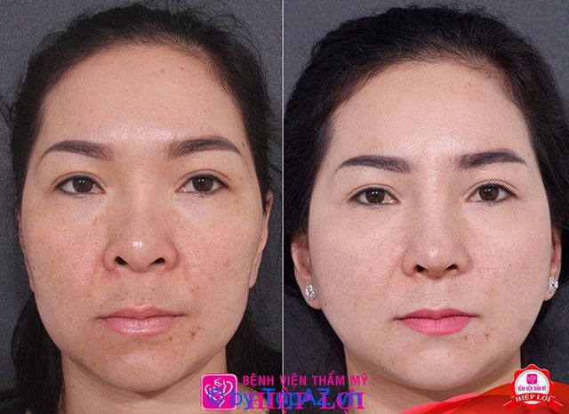 địa chỉ cấy mỡ trẻ hóa da tphcm