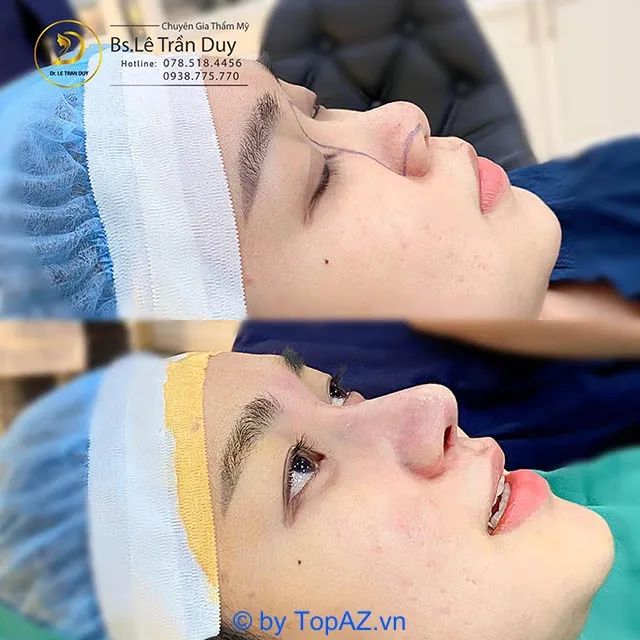 Đẳng cấp nâng mũi trả góp cao cấp tại TP.HCM - Dr.Duy thiết kế nét đẹp hoàn mỹ
