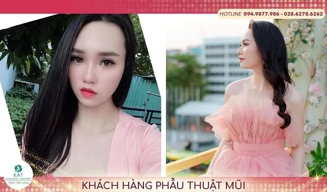 Khách hàng hài lòng sau khi thu gọn cánh mũi tại Khoa Thảo