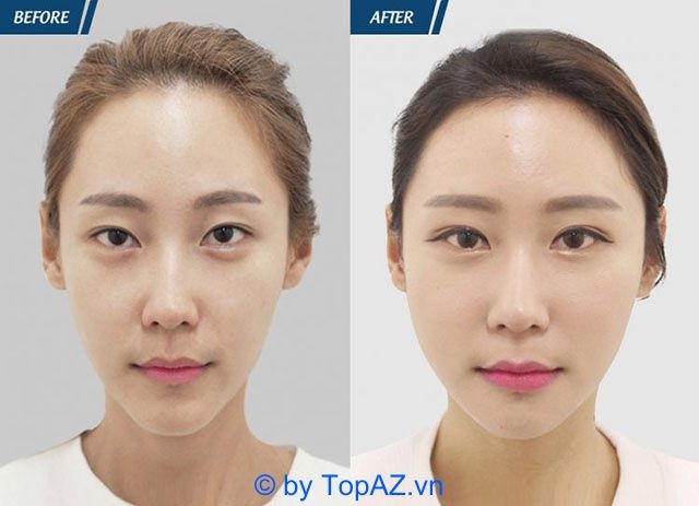 Địa chỉ cấy mỡ trẻ hóa da uy tín tại TPHCM