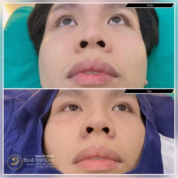 Từ chiếc mũi thô cứng đã được bác sĩ Duy điêu khắc thành dáng mũi hài hòa, cân đối