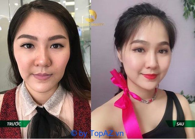 địa chỉ cấy mỡ trẻ hóa da tphcm