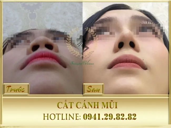 Dịch vụ cắt cánh mũi chuẩn y khoa tại Thẩm mỹ viện Sài Gòn Venus