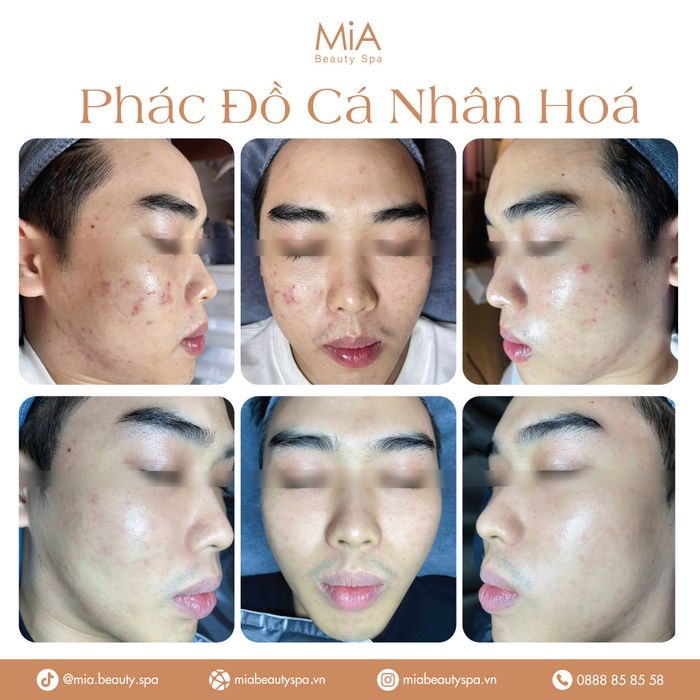 Góc nhìn hoàn mỹ tại MiA Beauty Spa – Ảnh 1