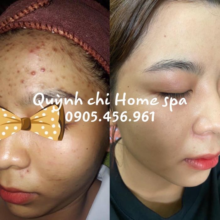 Hình ảnh liệu trình chăm sóc da tại Quỳnh Chi Home Spa