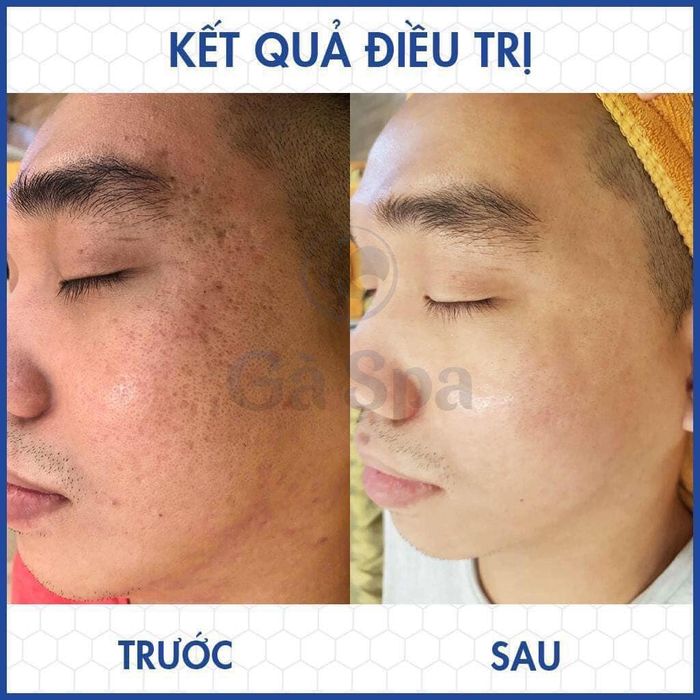 Hình ảnh trị liệu chuyên nghiệp tại Gà Spa