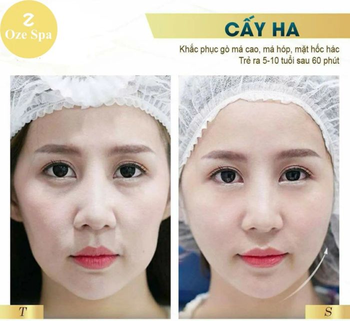 Hình ảnh quy trình điều trị chuyên nghiệp tại Oze Spa