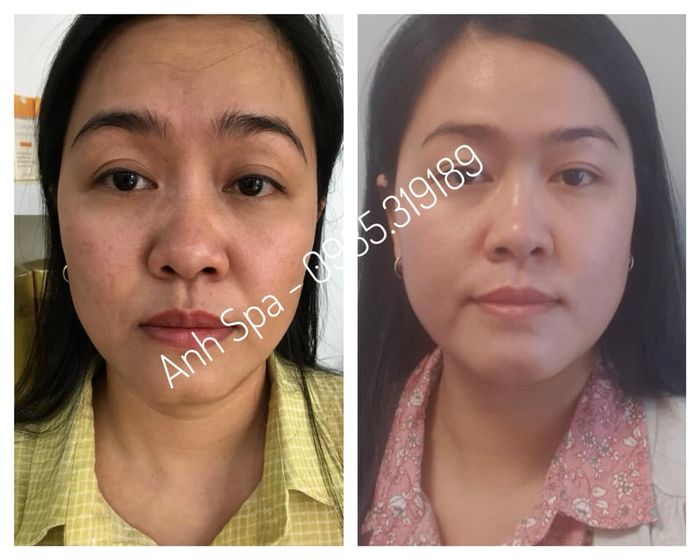 Không gian trị liệu đẳng cấp tại Anh Spa