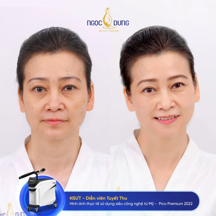 Chiêm ngưỡng làn da mộc của NSUT- diễn viên Tuyết Thu sau khi điều trị tại Thẩm Mỹ Viện Ngọc Dung