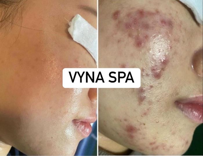 Hình ảnh trị liệu chuyên sâu tại VyNa Spa