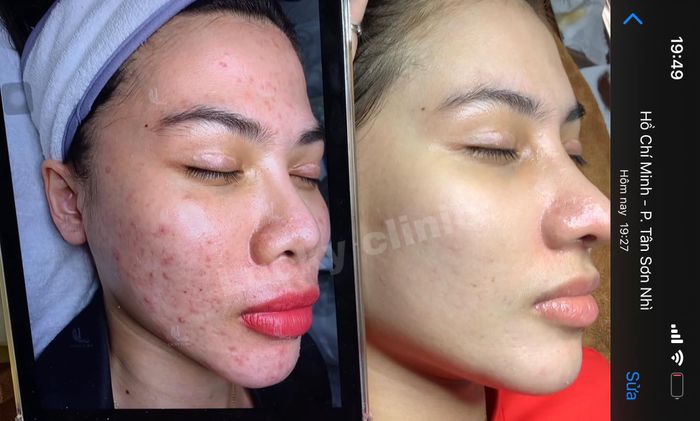 Quy trình trị mụn chuyên nghiệp tại Lucky Spa