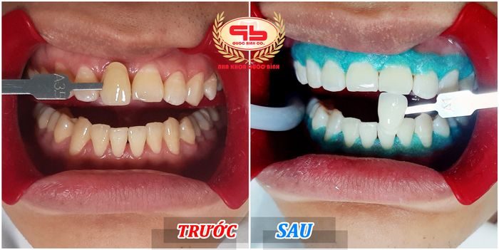 Thư viện hình ảnh Nha Khoa Quốc Bình - Nơi chăm sóc nụ cười chuyên nghiệp