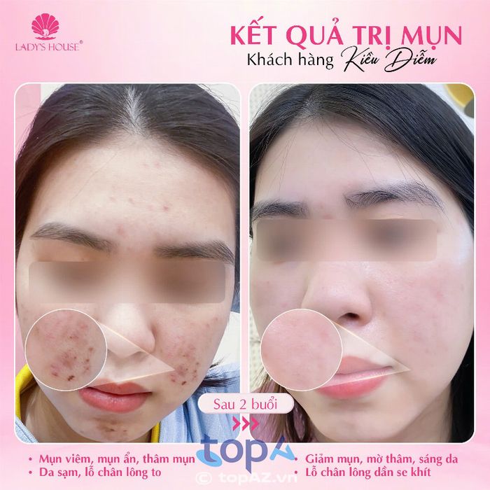 Lady's House Spa & Clinic - Địa chỉ trị mụn chuẩn y khoa tại Thủ Dầu Một