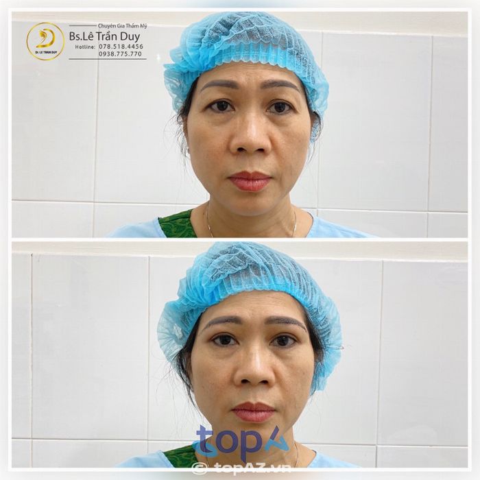 Các Địa Chỉ Treo Chân Mày Tại TPHCM Uy Tín