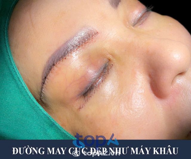 Địa chỉ uy tín thực hiện treo chân mày tại TPHCM