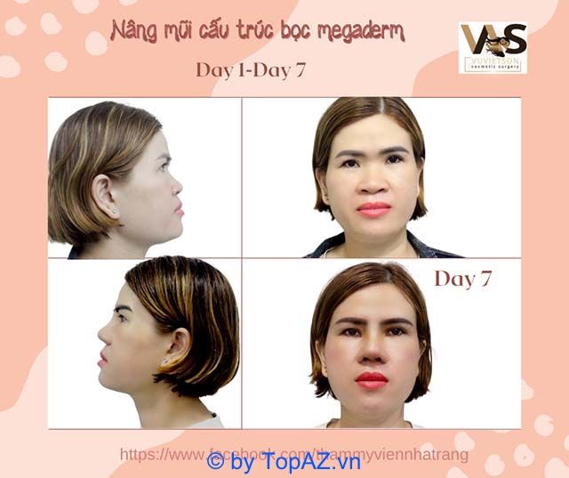 địa chỉ nâng mũi uy tín tại Nha Trang