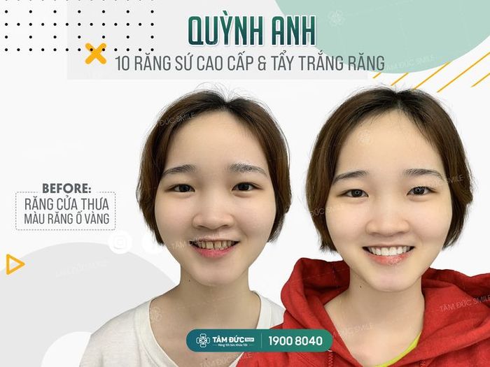 Hình ảnh thực tế quy trình tẩy trắng chuẩn y khoa tại Nha Khoa Tâm Đức Smile