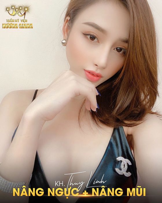 Kết quả nâng mũi ấn tượng tại Hương Giang