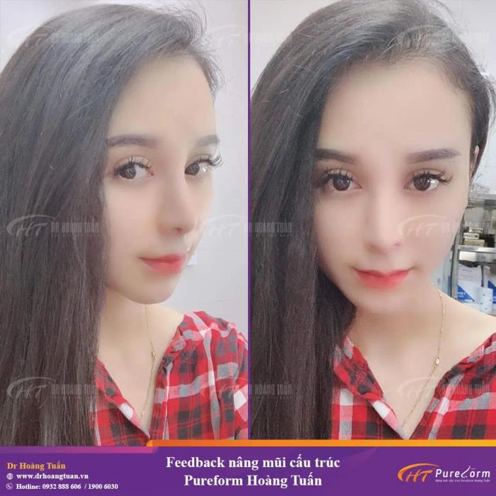 Kết quả nâng mũi ấn tượng tại Dr. Hoàng Tuấn