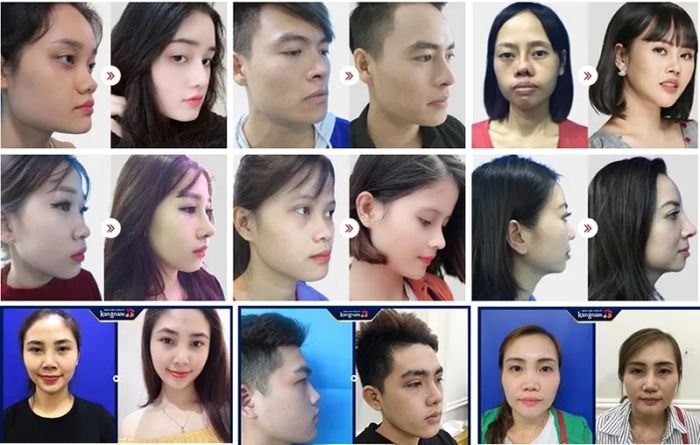 Khách hàng hài lòng sau khi nâng mũi tại Kangnam