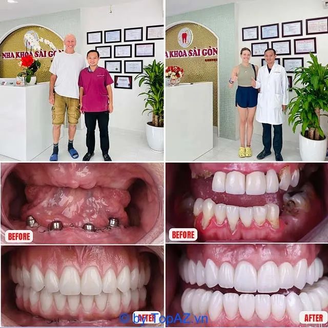 Chuyên gia cấy ghép răng tại TP.HCM
