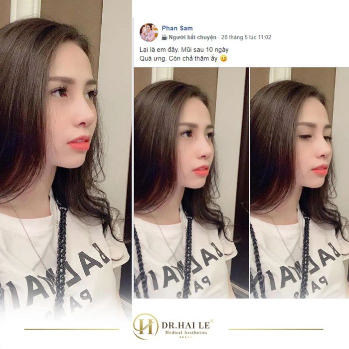 Hình ảnh thực tế về kết quả nâng mũi tại Dr.Hải Lê