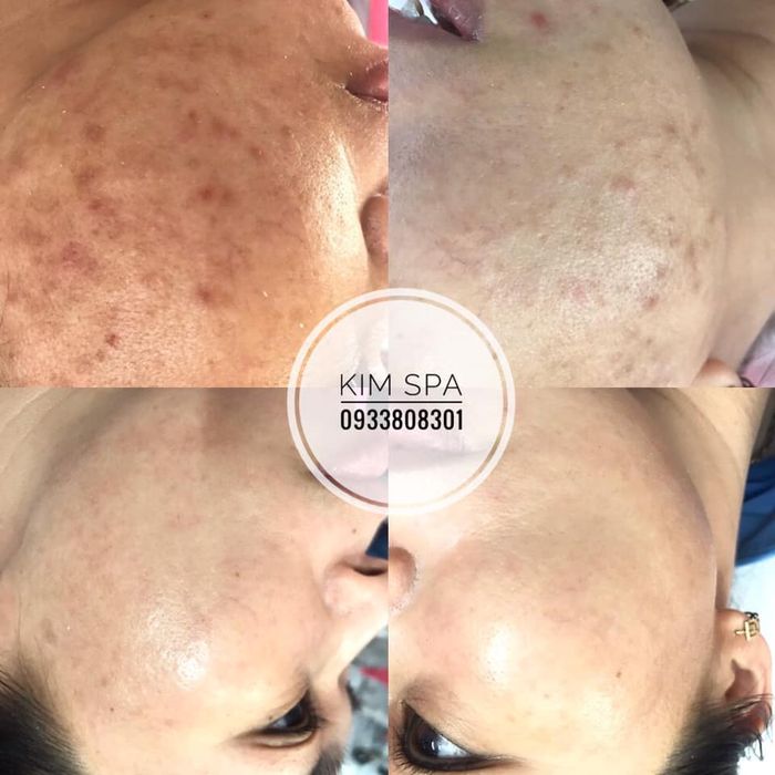 Quy trình điều trị da chuyên nghiệp tại Kim Beauty Spa - Ảnh 2