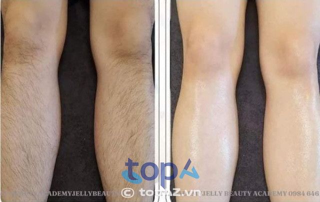 Spa triệt lông hiệu quả tại Thủ Đức