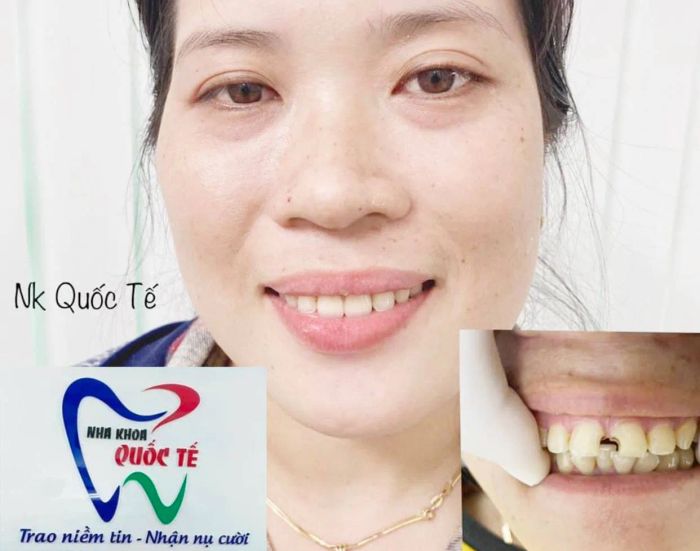 Nha Khoa Quốc Tế - Cơ sở uy tín tại Tân Uyên