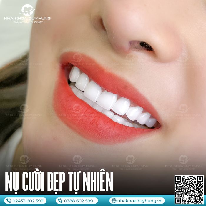 Bộ sưu tập hình ảnh chất lượng cao về quy trình điều trị tại Nha Khoa Duy Hưng