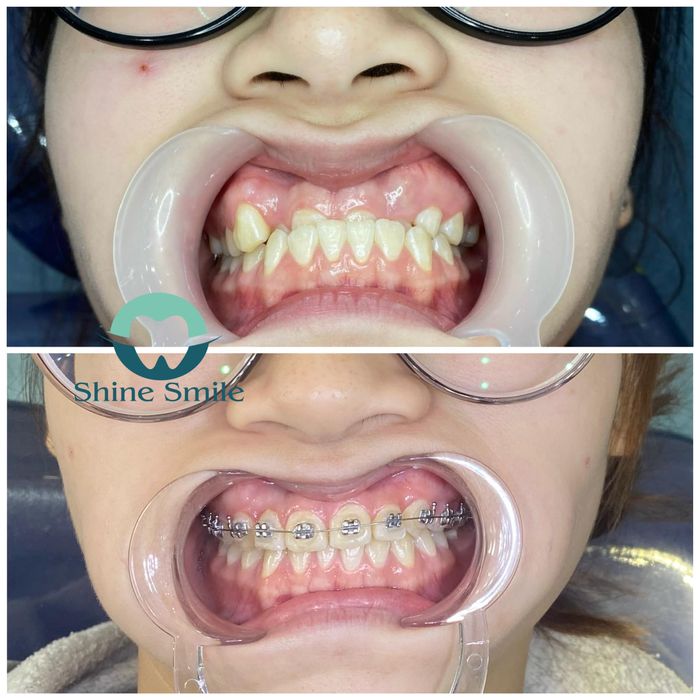 Hình ảnh Nha Khoa Quốc Tế Shine Smile 2