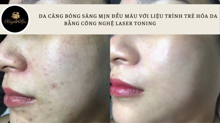 Quy trình trị mụn chuyên nghiệp tại Huyền Spa