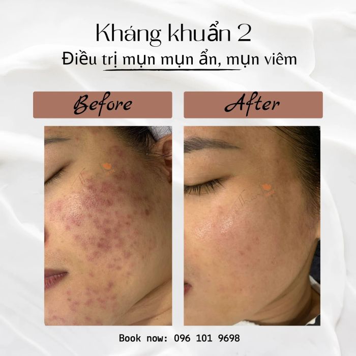 Hình ảnh liệu trình chăm sóc da cao cấp tại Thanh Skin - Cầu Giấy