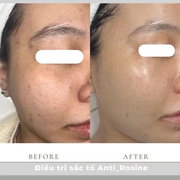 Hình ảnh liệu trình chăm sóc da cao cấp tại Ẩm Spa & Clinic