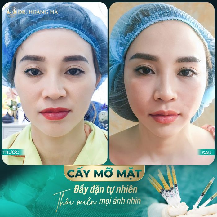 Thư viện hình ảnh khách hàng trước và sau phẫu thuật tại Thẩm mỹ viện Dr. Hoàng Hà