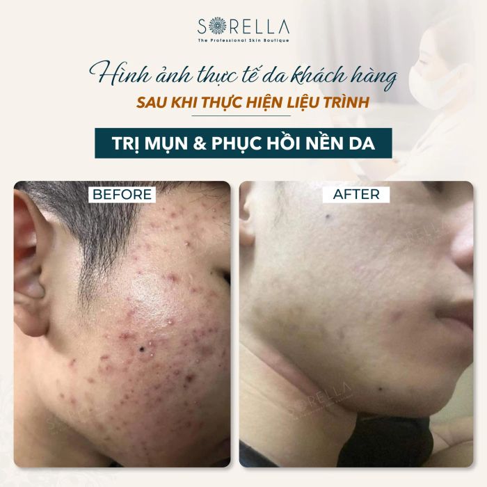 Hình ảnh trị liệu chuyên nghiệp tại Sorella Beauty Spa - Cầu Giấy, Hà Nội