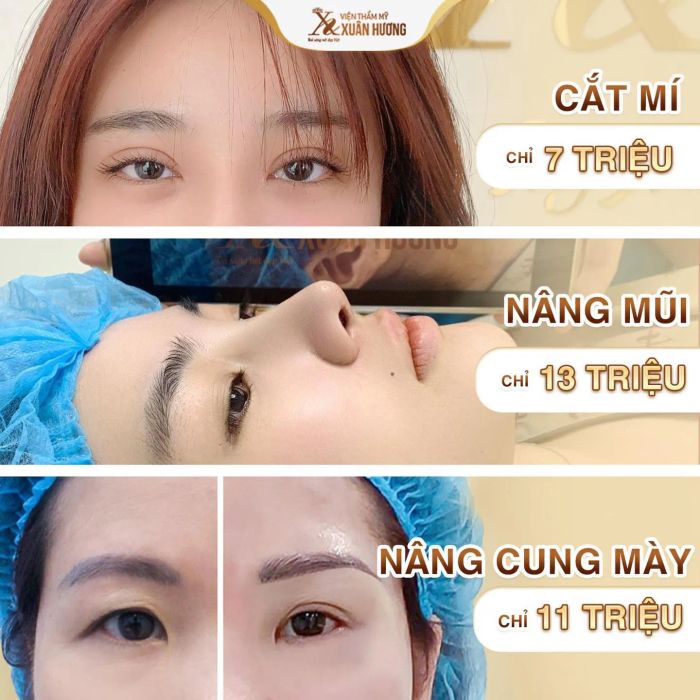 Thư viện hình ảnh kết quả phẫu thuật thẩm mỹ tại Xuân Hương