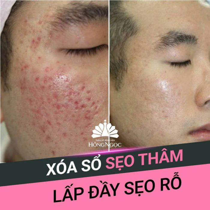 Hình ảnh phác đồ trị sẹo 3 trong 1 tại Hồng Ngọc