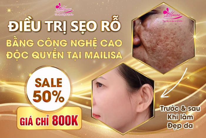 Hình ảnh trị liệu sẹo rỗ công nghệ cao tại Mailisa