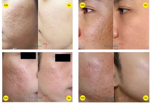 Hình ảnh công nghệ Scar Nano trị sẹo tại Kangnam