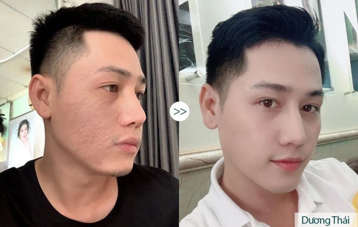 Hình ảnh công nghệ Bio Scar tại Đông Á