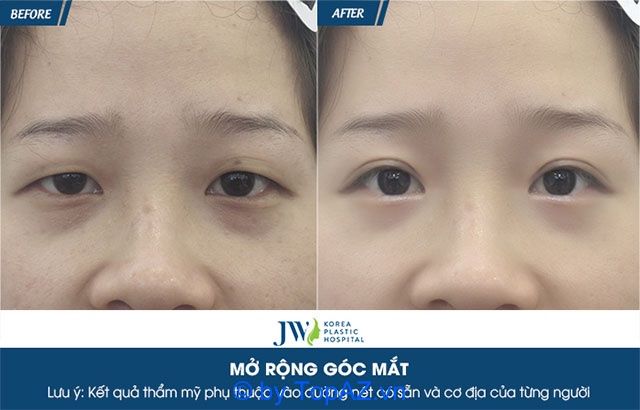 Mở rộng góc mắt ở đâu đẹp tại TP.HCM?