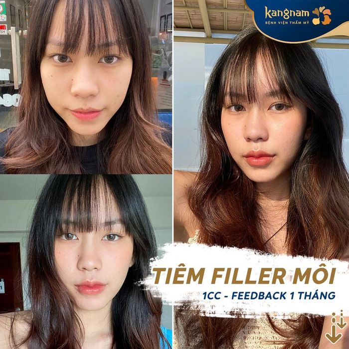 Bệnh viện thẩm mỹ Kangnam - Hình ảnh minh họa quy trình tiêm filler chuyên nghiệp
