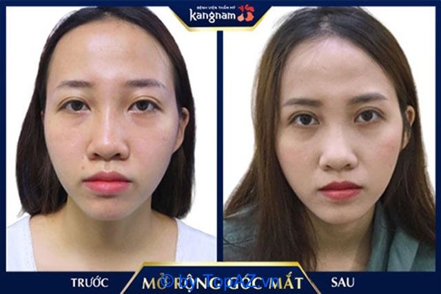 Mở rộng góc mắt ở đâu đẹp?