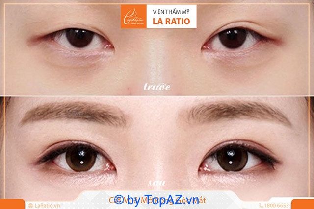 Mở rộng góc mắt ở đâu đẹp tại TP.HCM?